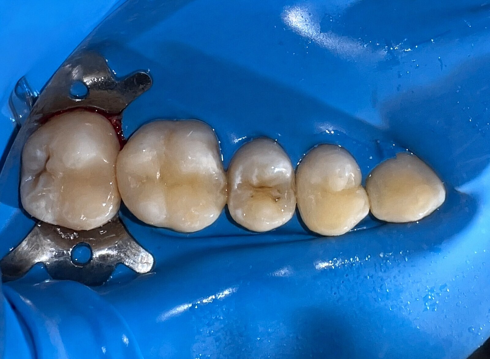 Photocomposite fillings – after treatment