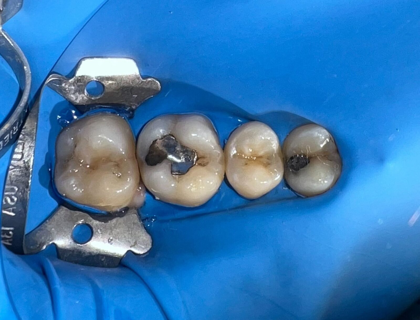 Photocomposite fillings – picture before treatment