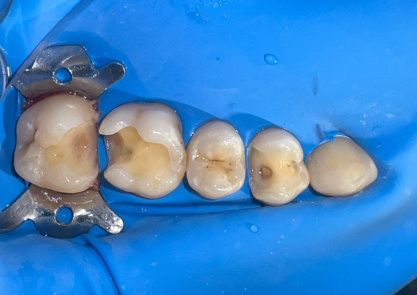 Photocomposite fillings – picture during treatment