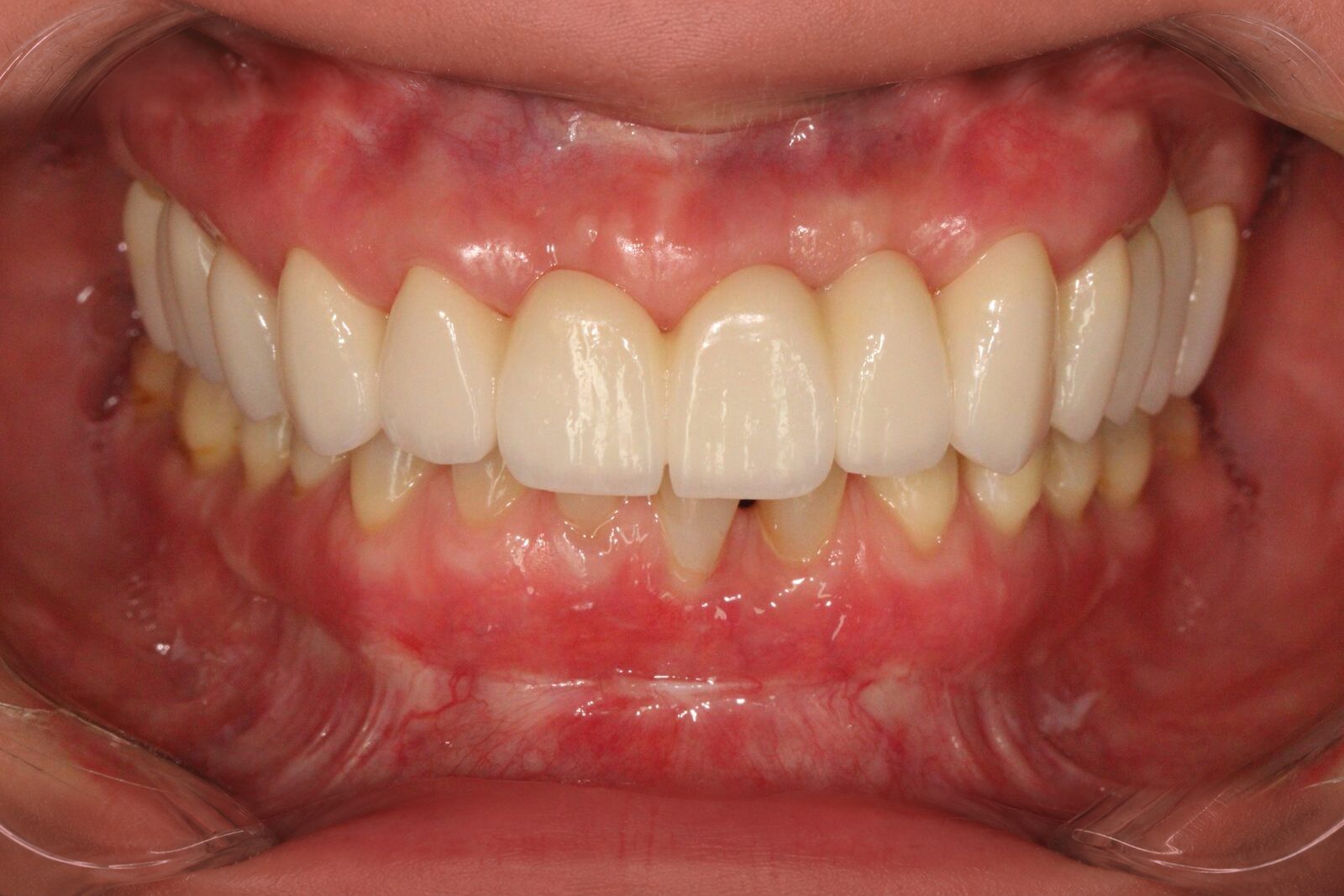 Complex conservative-periodontology-orthodontic-prosthetic reconstruction – after treatment