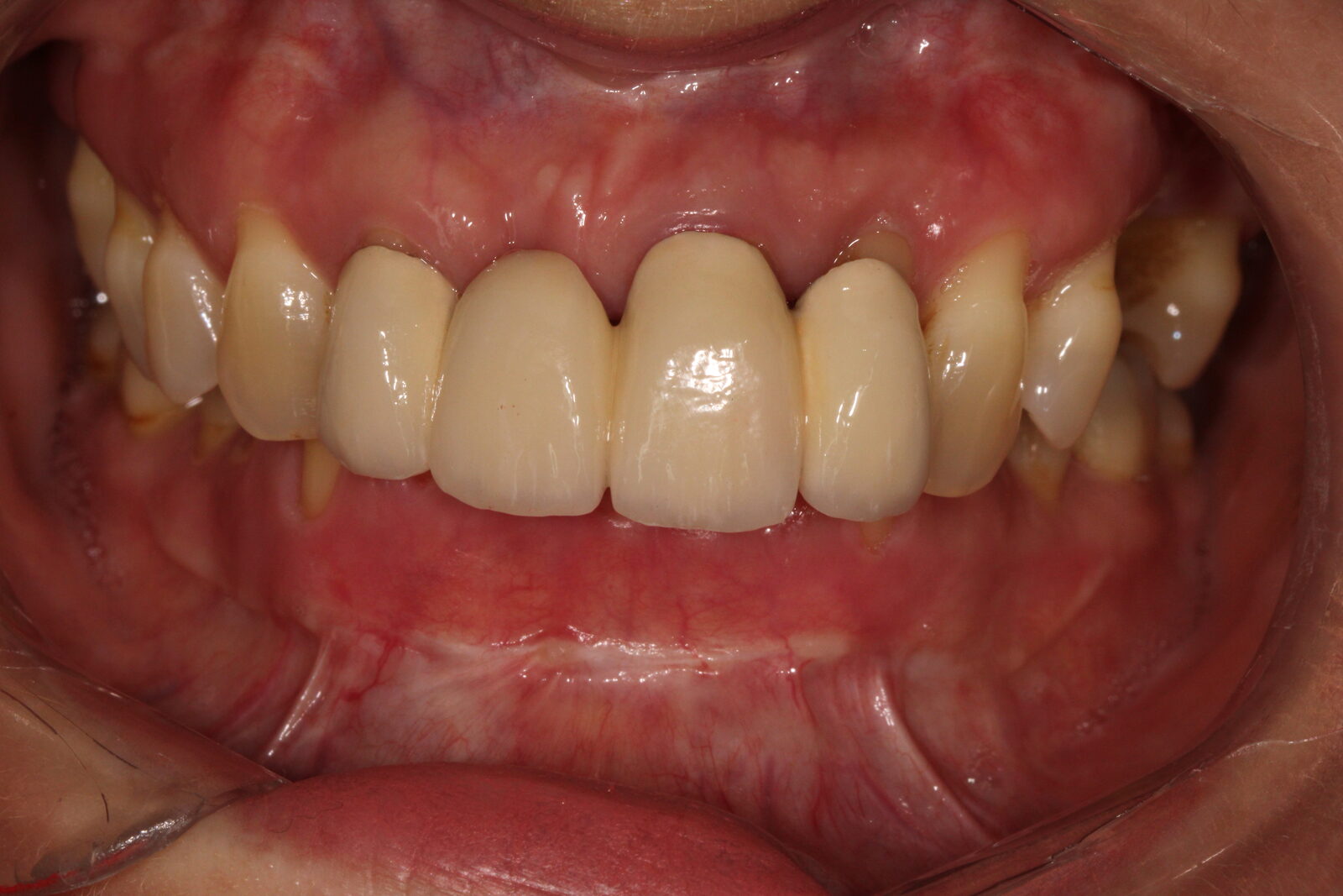 Complex conservative-periodontology-orthodontic-prosthetic reconstruction – picture before treatment