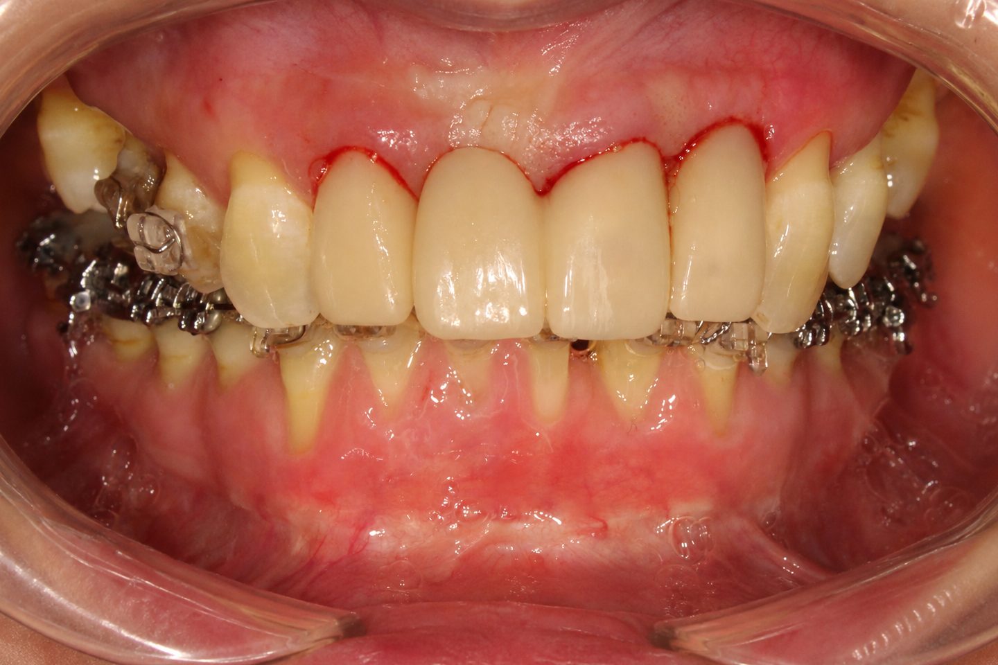 Complex conservative-periodontology-orthodontic-prosthetic reconstruction – picture during treatment