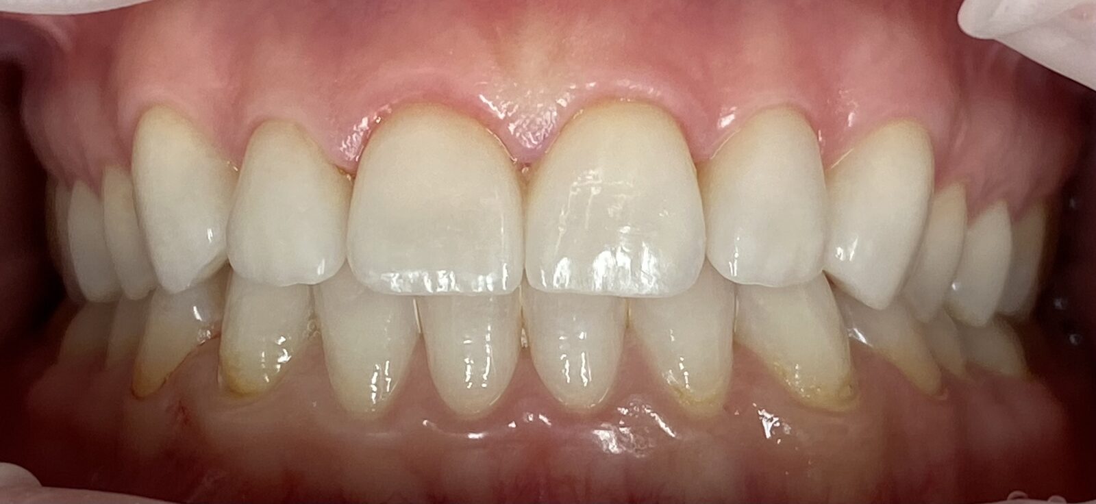 Ceramic veneers – after treatment
