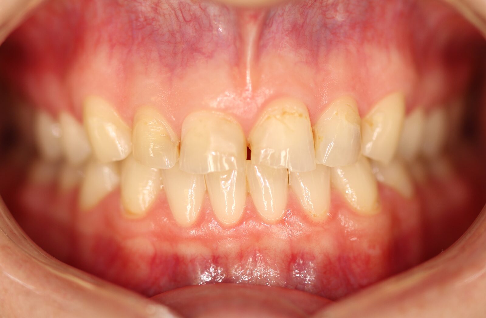 Ceramic veneers – picture before treatment