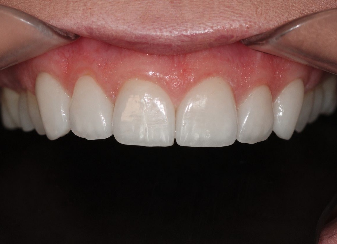 Complex reconstruction with bite elevation – after treatment