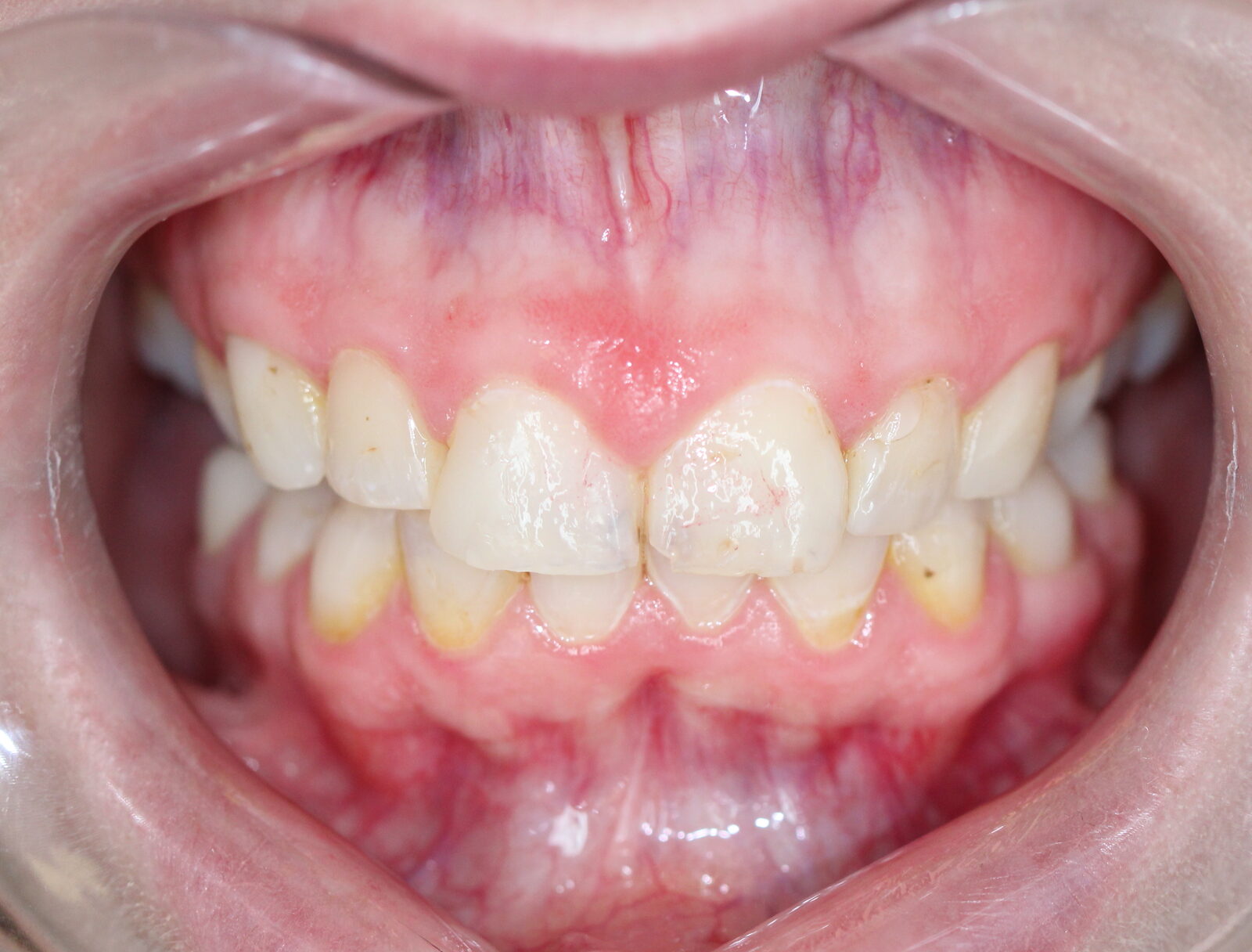 Complex reconstruction with bite elevation – picture before treatment