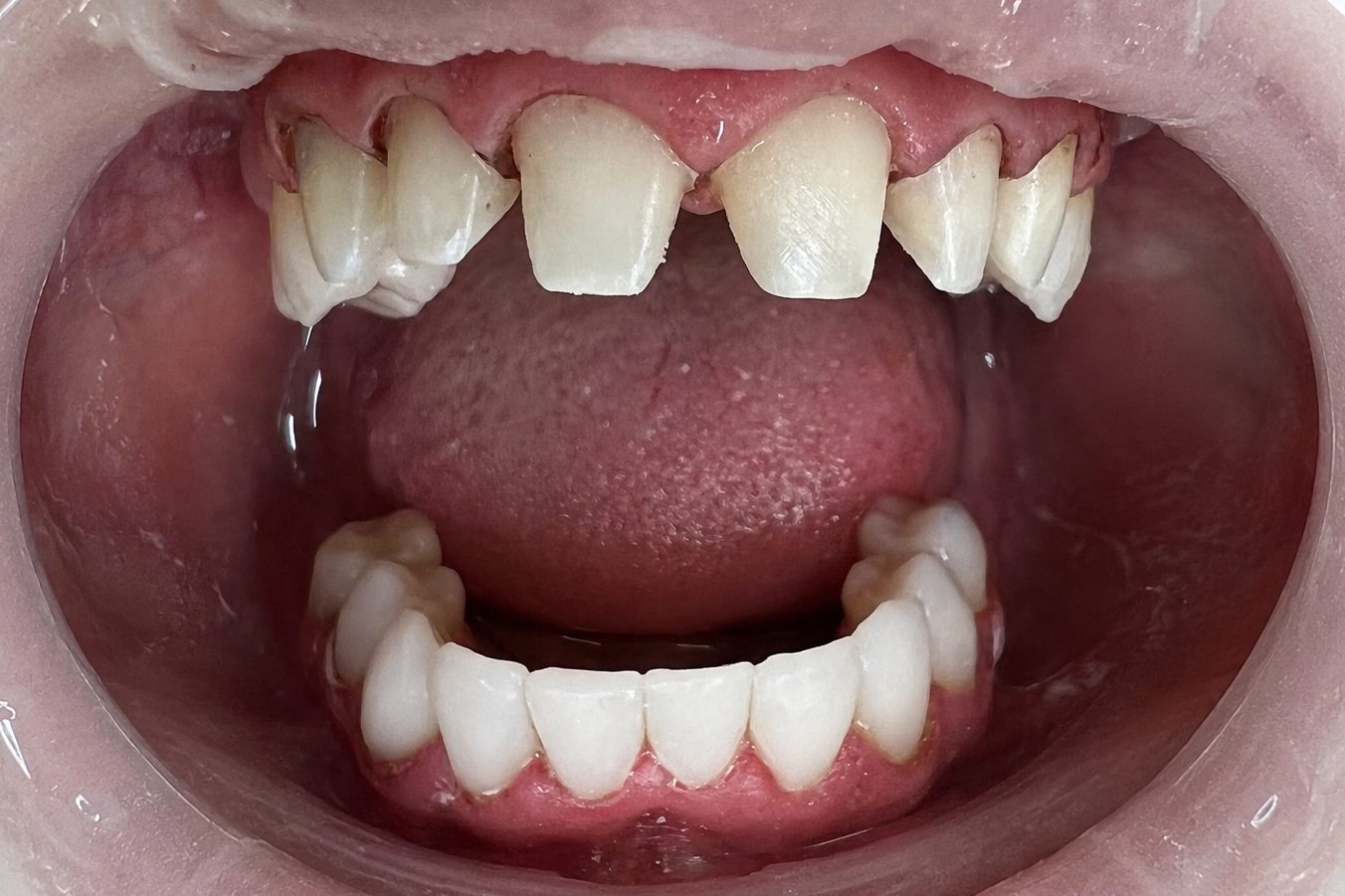 Complex reconstruction with bite elevation – picture during treatment