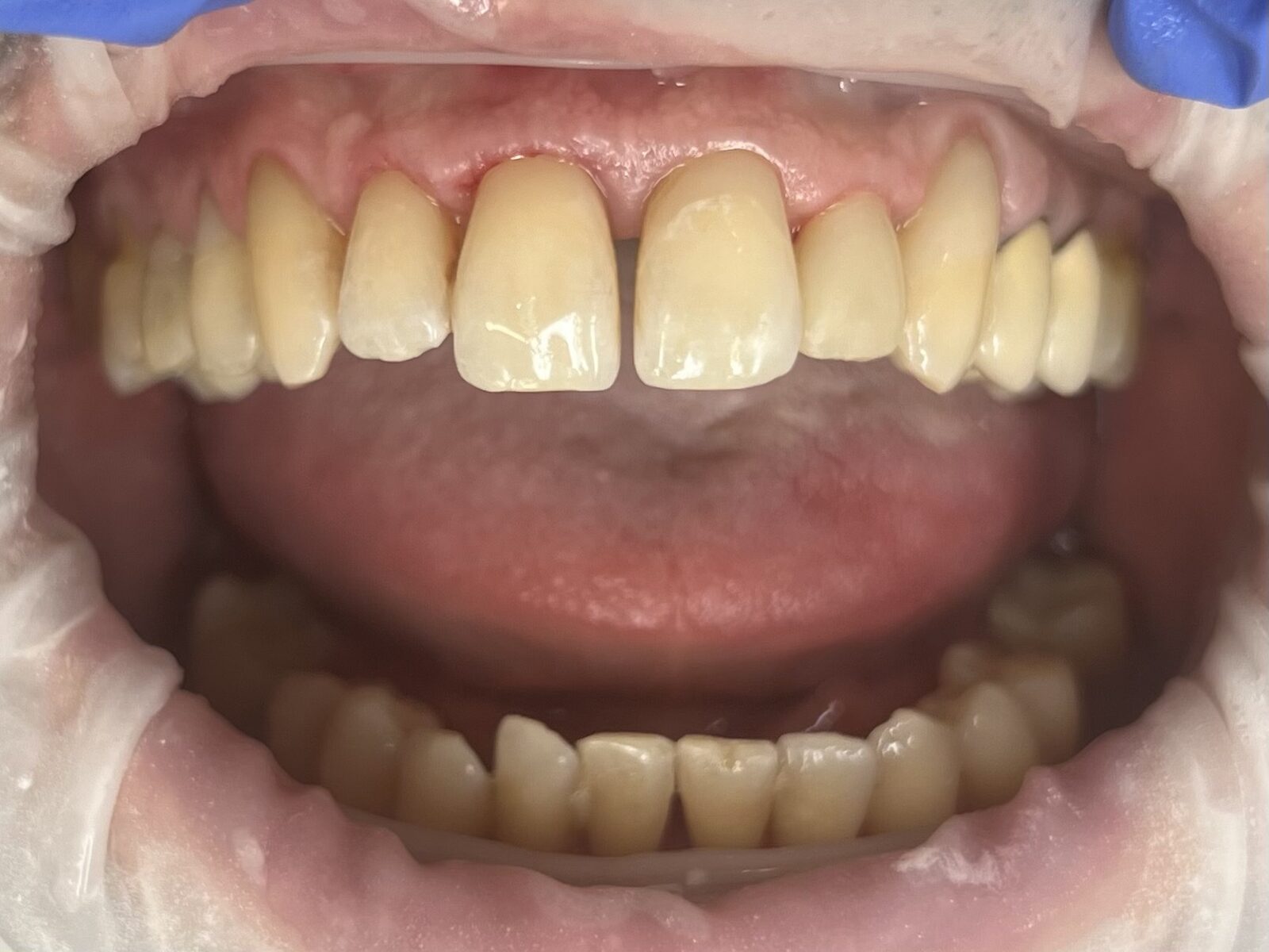 Photocomposite fillings and build-ups, orthodontic extrusion of an “untreatable” tooth – after treatment