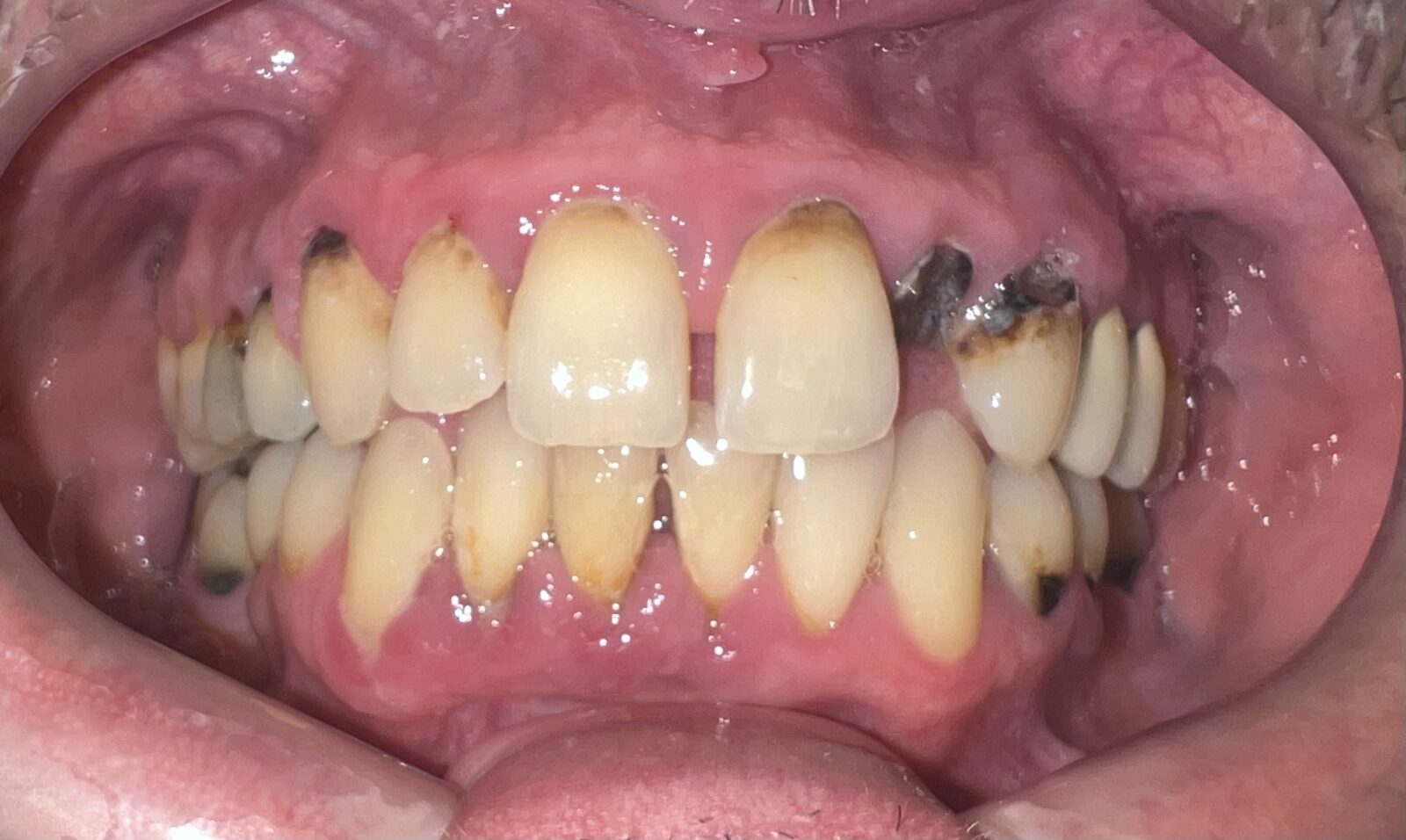 Photocomposite fillings and build-ups, orthodontic extrusion of an “untreatable” tooth – picture before treatment