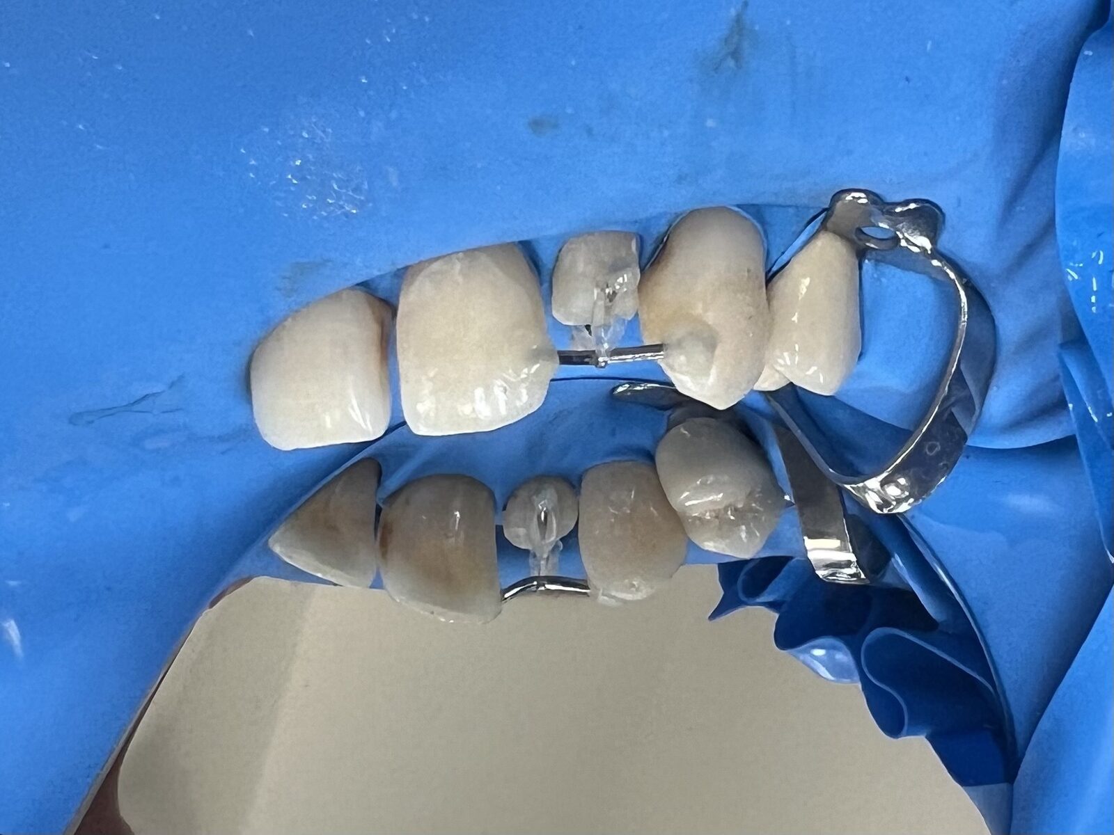 Photocomposite fillings and build-ups, orthodontic extrusion of an “untreatable” tooth – picture during treatment