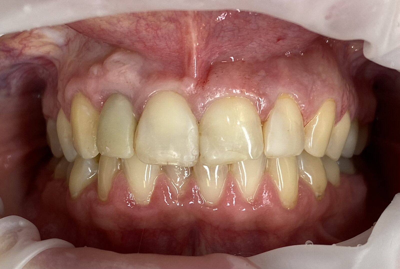 Esthetic reconstruction of frontal incisors – implant of right No. 2, ceramic veneers – picture before treatment