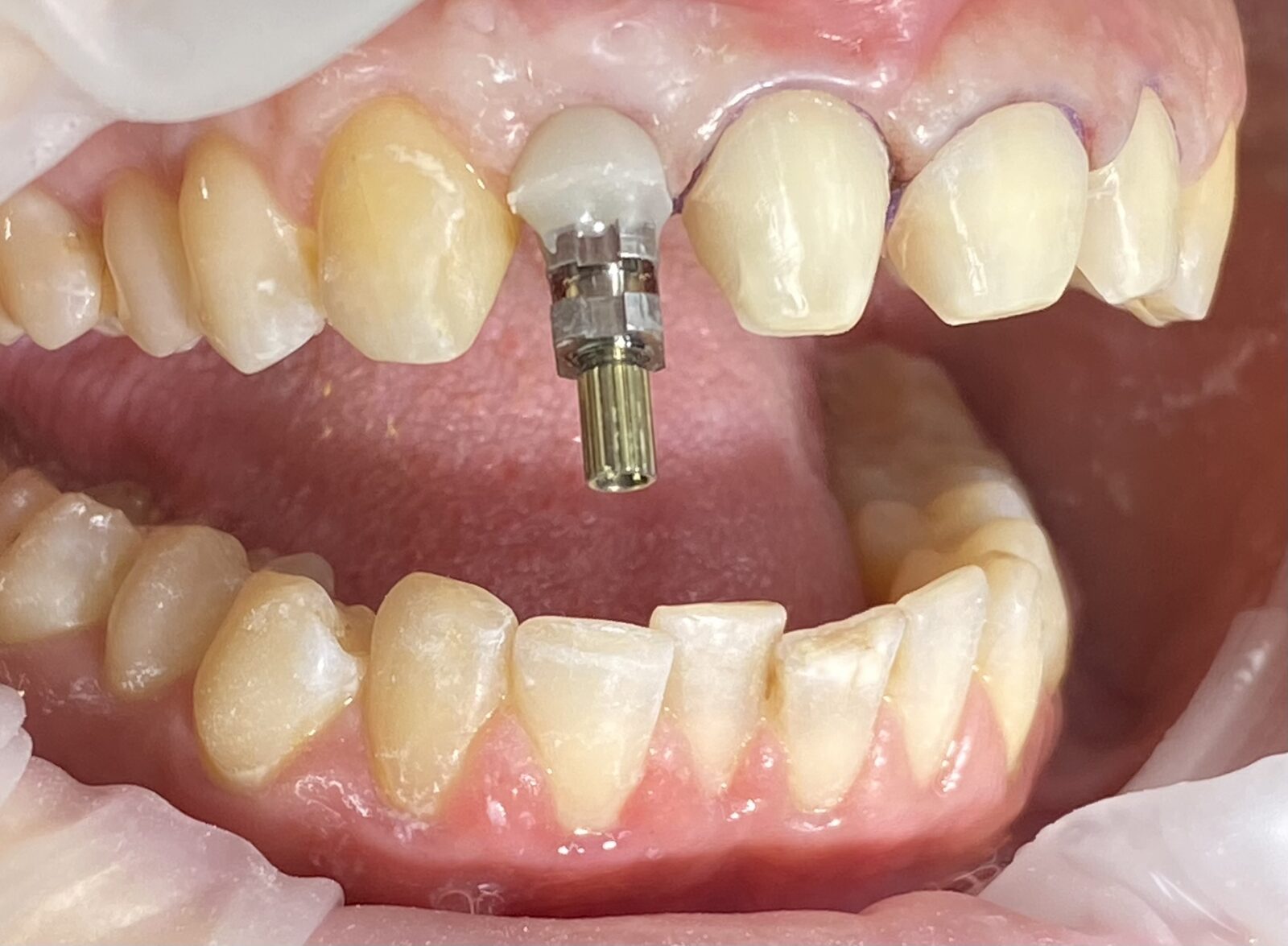 Esthetic reconstruction of frontal incisors – implant of right No. 2, ceramic veneers – picture during treatment
