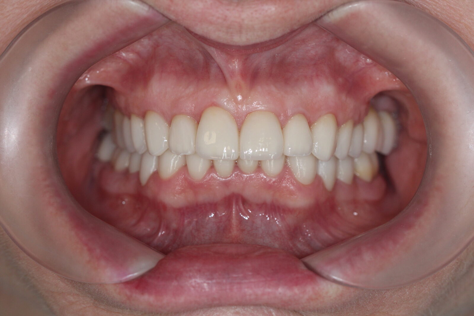 Complex reconstruction with bite elevation – after treatment