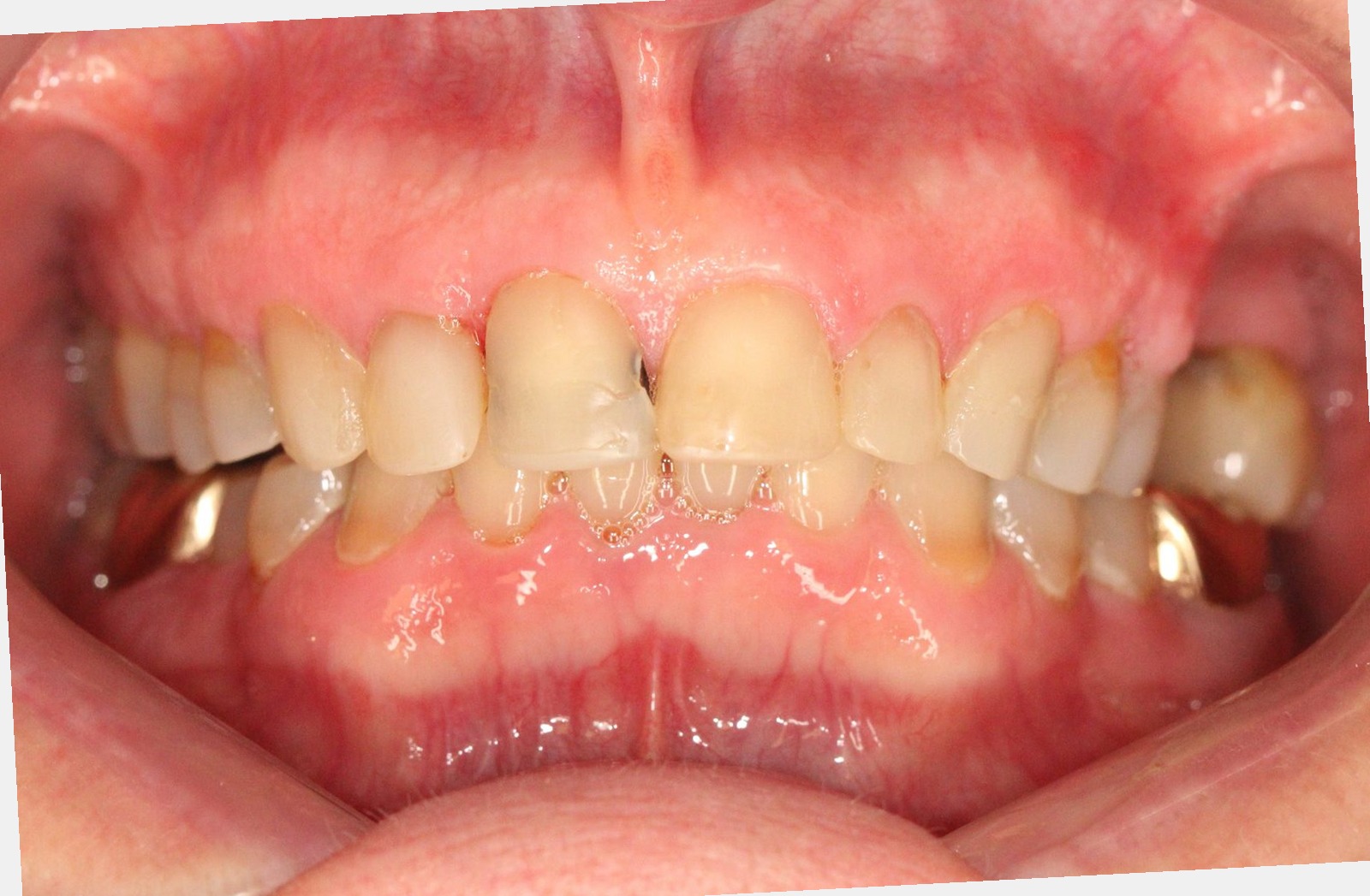 Complex reconstruction with bite elevation – picture before treatment