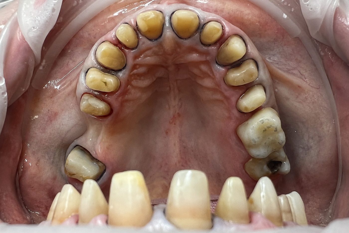 Complex reconstruction with bite elevation – picture during treatment