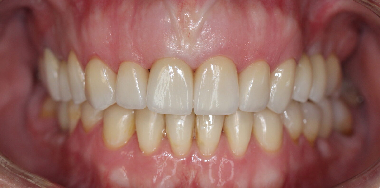Esthetic reconstruction of front teeth – after treatment