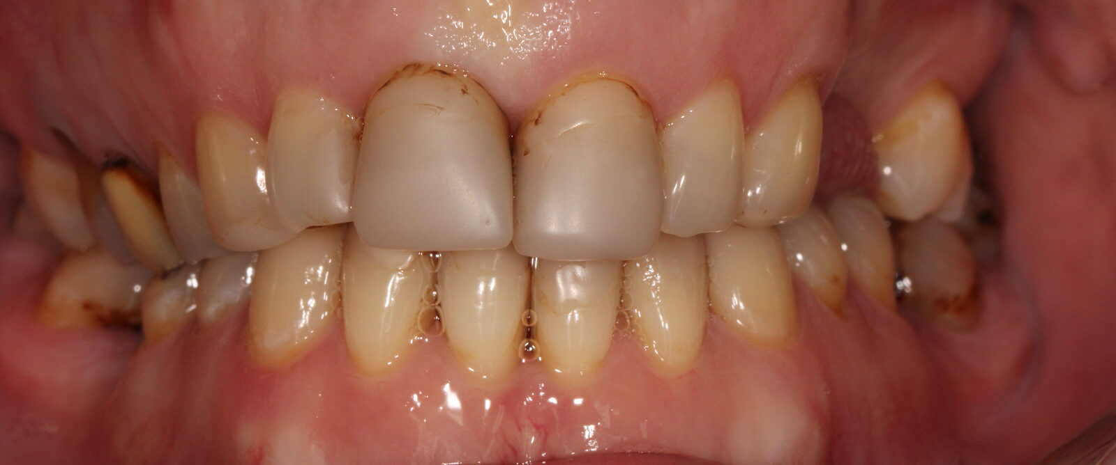 Esthetic reconstruction of front teeth – picture before treatment