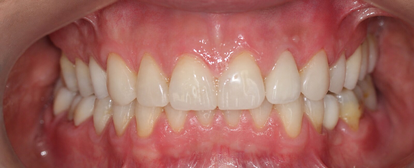 Comprehensive reconstruction with bite elevation – after treatment