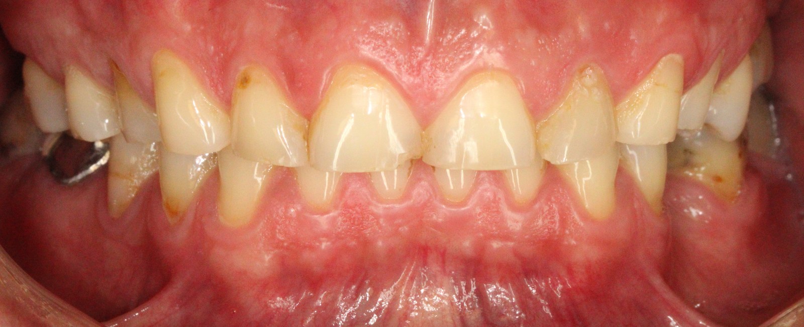 Comprehensive reconstruction with bite elevation – picture before treatment