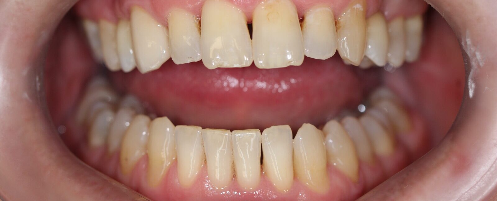 Dental reconstruction and esthetic treatment – after treatment