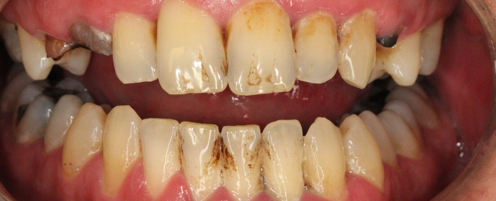 Dental reconstruction and esthetic treatment – picture before treatment