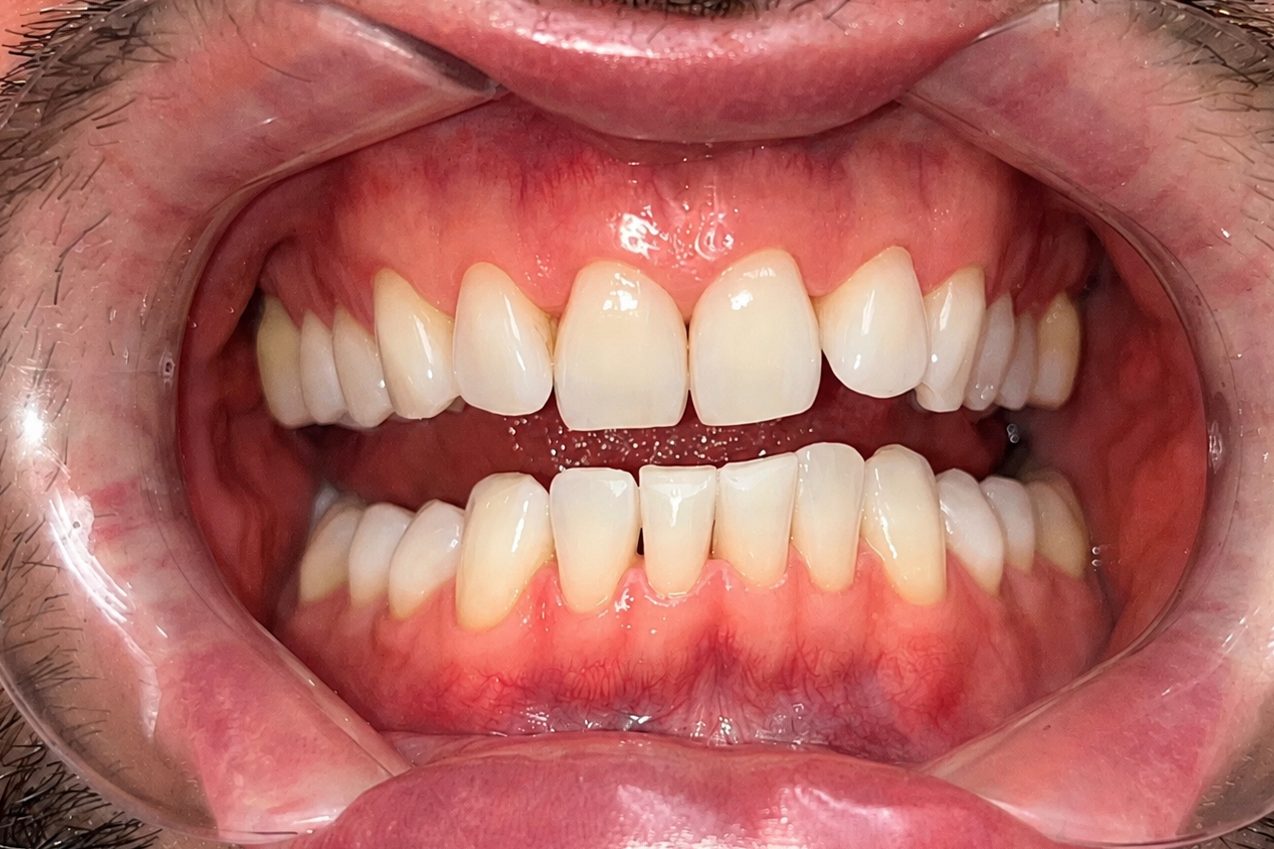 Result of combined teeth whitening – after treatment