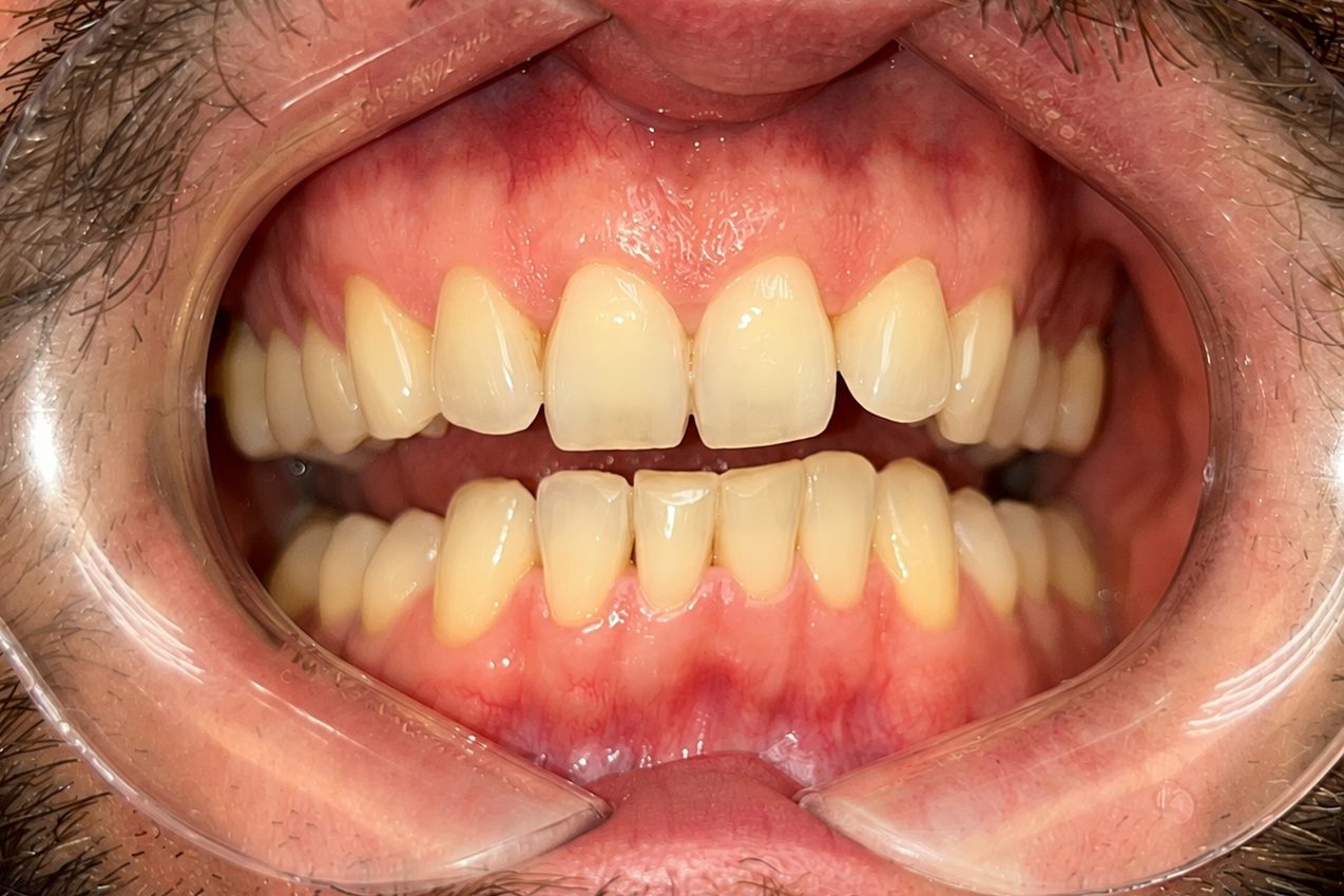Result of combined teeth whitening – picture before treatment